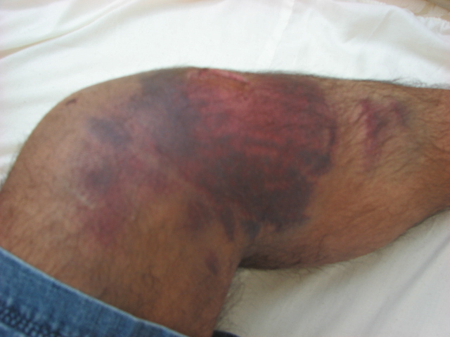 Severe bruises caused by car accident