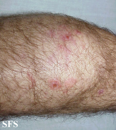 File:Dermatitis herpetiformis25.jpg