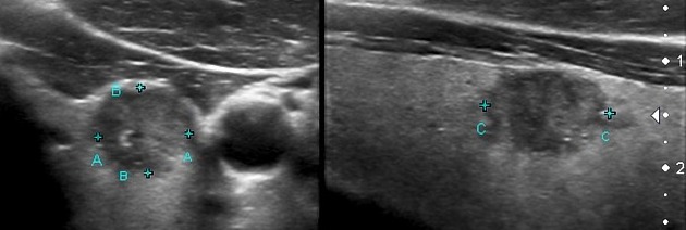 File:Papillary thyroid cancer Ultrasound 04.jpeg