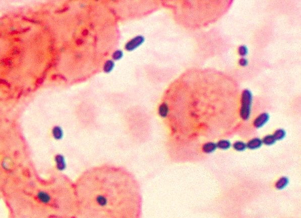 Enterococcus sp. infection in pulmonary tissue.