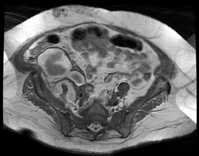 File:Retroperitoneal hematoma MRI 001.jpg