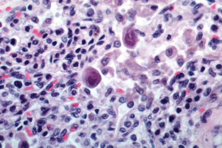 Lung: Cytomegalic Inclusion Body Disease: Micro high mag H&E. Inclusions are well demonstrated.