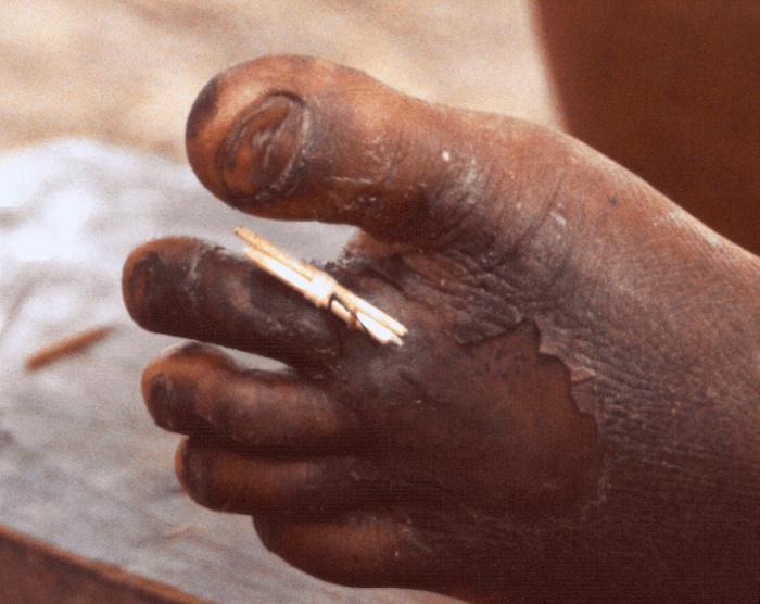 Subcutaneous emergence of a female Guinea worm, Dracunculus medinensis, from the dorsum of a sufferer’s left foot at the proximal surface of the second toe. From Public Health Image Library (PHIL). [8]