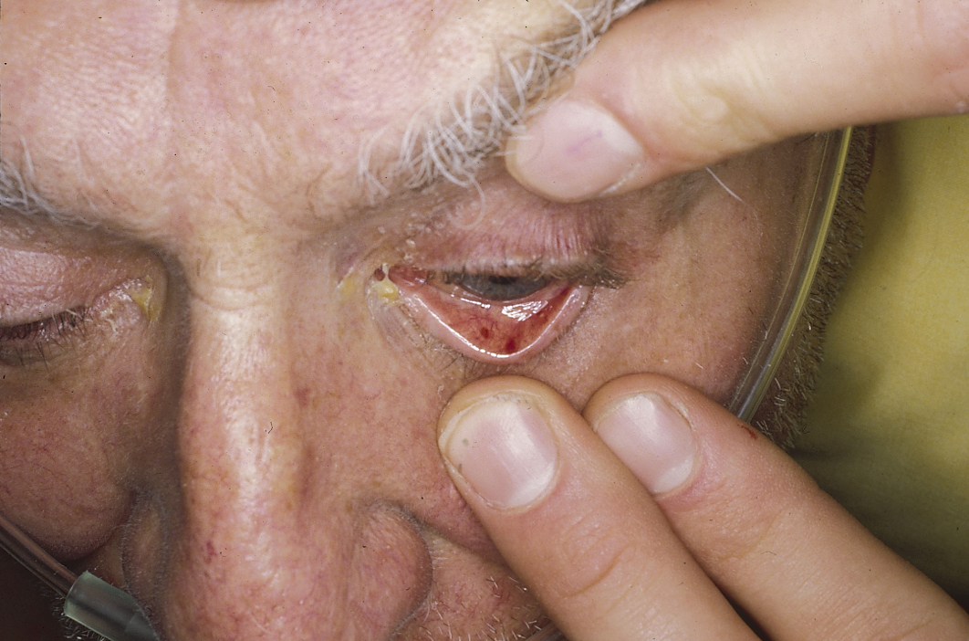 Conjunctival Petechiae: Conjunctival petechiae, in this case secondary to endocarditis. (Image courtesy of Josh Fierer, M.D and Charlie Goldberg, M.D.)