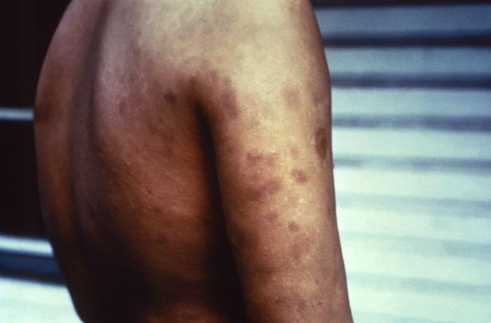 Lepromatous leprosy exhibiting erythema nodosum leprosum. Note numerous cutaneous erythematous blotchy lesions on patient’s back, right shoulder, and upper arm. Adapted from Public Health Image Library (PHIL), Centers for Disease Control and Prevention.[6]