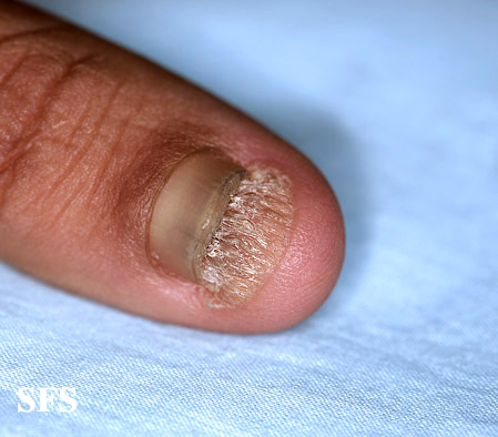 Onychomycosis. With permission from Dermatology Atlas.[6]