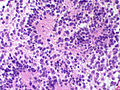 File:120px-Adrenal Neuroblastoma HP2 CTR.jpg