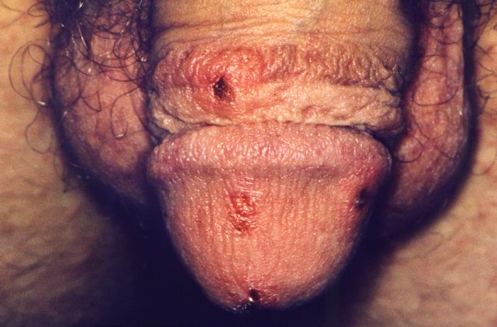 This close view of the genitalia of a male patient reveals the presence of erosive, inflamed lesions, which had been caused by an infestation of scabies, Sarcoptes scabiei var. hominis. The lesions are on the penile glans, and the preputial skin. The most common signs and symptoms of scabies are intense itching (pruritus), especially at night, and a pimple-like (papular) itchy rash. The itching and rash each may affect much of the body or be limited to common sites such as the wrist, elbow, armpit, webbing between the fingers, nipple, penis, waist, belt-line, and buttocks. The rash also can include tiny blisters (vesicles) and scales. Scratching the rash can cause skin sores; sometimes these sores become infected by bacteria. Adapted from CDC
