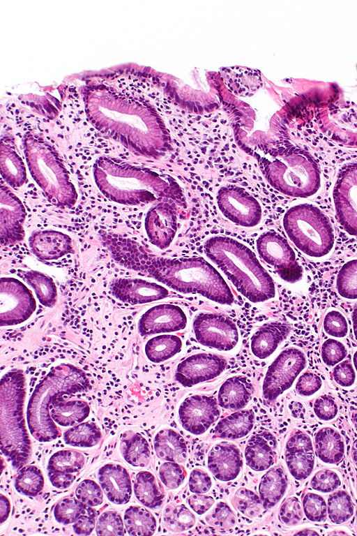 Chronic gastritis - Intermedicate Magnification, By Nephron (Own work) [CC BY-SA 3.0 (https://creativecommons.org/licenses/by-sa/3.0) or GFDL (http://www.gnu.org/copyleft/fdl.html)], via Wikimedia Commons [6]