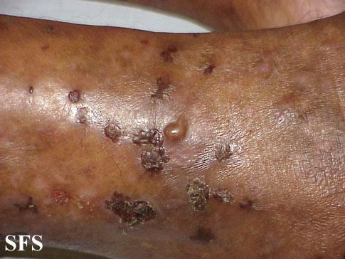 File:Dermatitis herpetiformis13.jpg