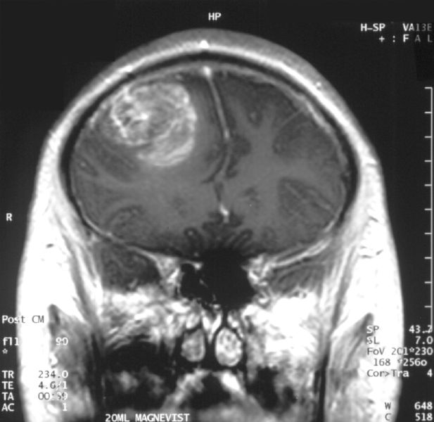 Image 1a. Coronal MRI with contrast of a glioblastoma WHO grade IV in a 15-year-old boy