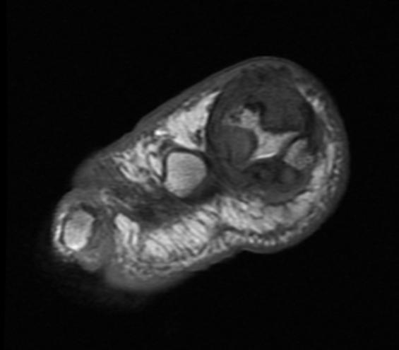 File:Gout MRI 001.jpg