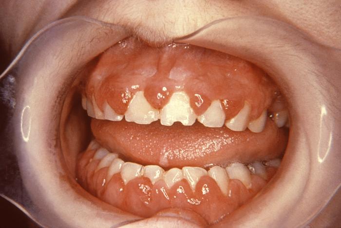 Patient with swollen gingivae was diagnosed with oral moniliasis secondary to monocytic leukemia. From Public Health Image Library (PHIL). [5]