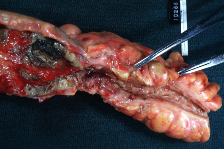 Colon: Necrotizing Enterocolitis: Gross, natural color, thickened constricted colon with linear ulcerations and mucosal hyperemia