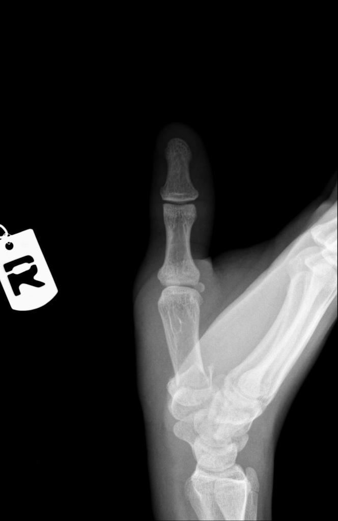 Lateral Fracture of base of the first metacarpal bone with mild to moderate displacement and without intra-articular extension.