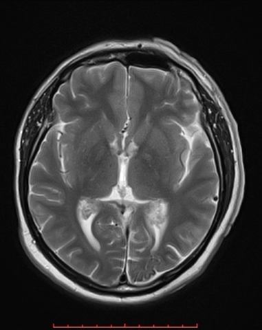 File:Sturge-weber-MRI.jpg