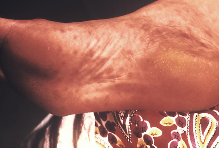 This patient presented with secondary syphilitic lesions on the plantar aspect of the foot. The second stage starts when one or more areas of the skin break into a rash that appears as rough, red or reddish brown spots both on the palms of the hands and on the bottoms of the feet. Even without treatment, rashes clear up on their own. Adapted from CDC