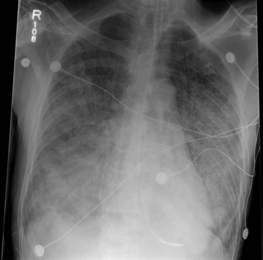 Chest X-ray of an individual with Pneumocystis jirovecii pneumonia[2]