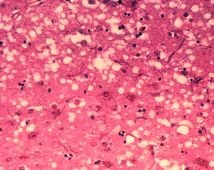 Micrograph of brain tissue reveals the cytoarchitectural histopathologic changes found in bovine spongiform encephalopathy. From Public Health Image Library (PHIL). [3]