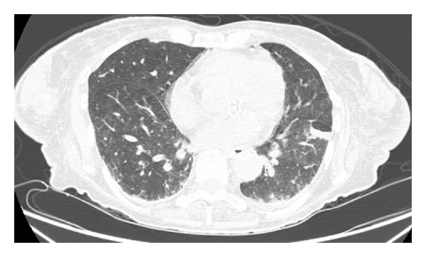 Computed tomography (CT) scan of the chest showed diffuse interstitial thickening and ground glass opacities.[1]