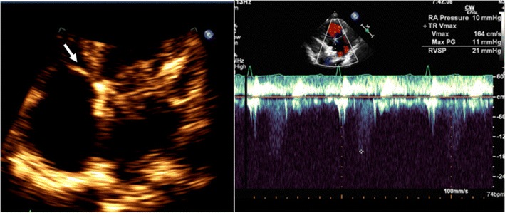File:Normal echocardiographic appearance of tricuspid valve.jpg