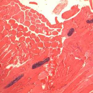 Sarcocysts of Sarcocystis sp. in muscle tissue, stained with H&E. Image courtesy of the William Beaumont Hospital, Royal Oak, MI. Adapted from CDC
