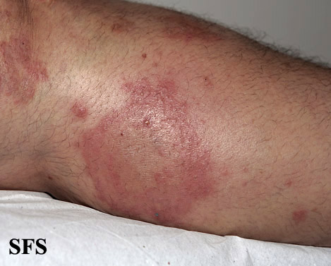 File:Dermatitis herpetiformis41.jpg