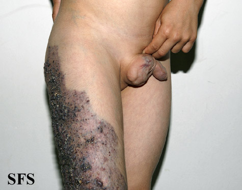 Klippel Trenaunay Syndrome. Adapted from Dermatology Atlas.[7]
