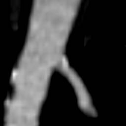 Atherosclerotic plaques seen in the distal aortic arch, aortic bifurcation, and in the external iliac arteries. right renal artery stenosis. A 74 year-old male who is status post thromboembolic event of his RLE.