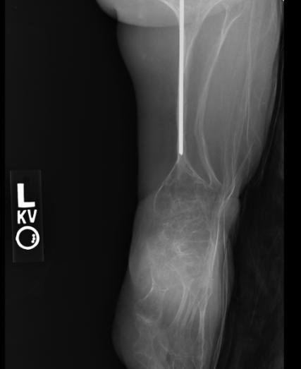 File:Osteogenesis-imperfecta-105.jpg
