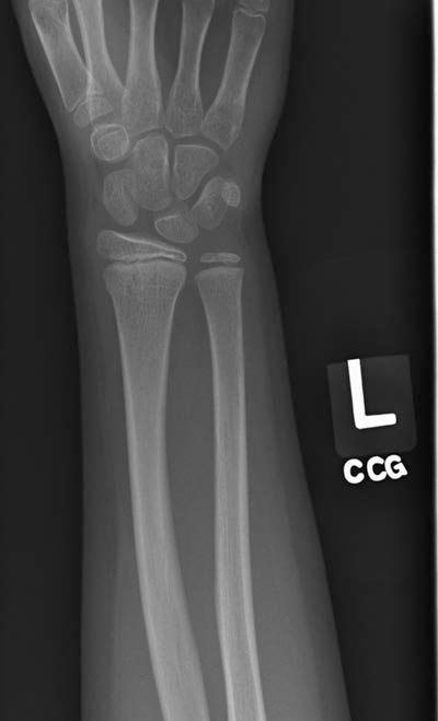 Plain x-ray: Torus fracture