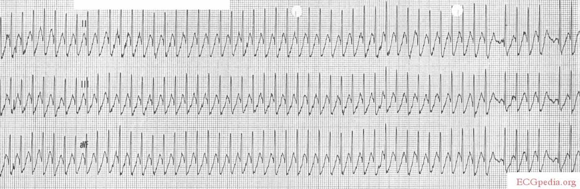 File:Atrial Flutter with WPW.jpg