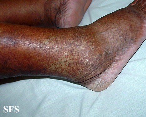 Atrophie Blanche. Adapted from Dermatology Atlas.<ref name="Dermatology Atlas">{{Cite