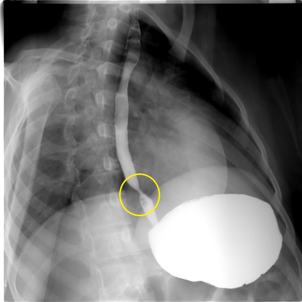 File:Benign-oesophageal-stricture.jpg