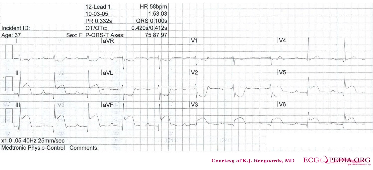 Sinus bradycardia with first degree AV block and inferior-posterior-lateral myocardial infarction.