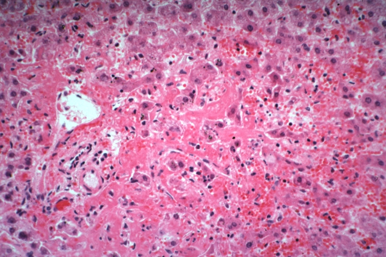 Lupus erythematosus hepatitis: Micro high mag H&E, periportal sinus thrombosis with liver cell necrosis and noninflammatory infiltrate (possibly viral). A 19yo female with lupus erythematosus