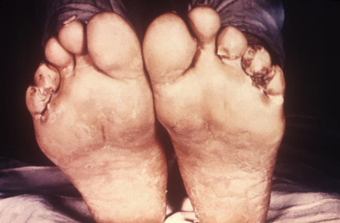 This image depicts the soles of both feet of a syphilis patient revealing the presence of secondary syphilitic lesions consisting of erosive dermal regions of the toes, mainly involving the intertriginous spaces between the toes. Secondary syphilitic lesions consist of skin rashes and/or sores in the mouth, vagina, or anus (also called mucous membrane lesions) mark the secondary stage of symptoms. This stage usually starts with a rash on one or more areas of the body. Rashes associated with secondary syphilis can appear from the time when the primary sore is healing to several weeks after the sore has healed. The rash usually does not cause itching. This rash may appear as rough, red, or reddish brown spots both on the palms of the hands and/or the bottoms of the feet. However, this rash may look different on other parts of the body and can look like rashes caused by other diseases Large, raised, gray or white lesions may develop in warm, moist areas such as the mouth, underarm or groin region. Sometimes rashes associated with secondary syphilis are so faint that they are not noticed. Other symptoms of secondary syphilis include fever, swollen lymph glands, sore throat, patchy hair loss, headaches, weight loss, muscle aches, and fatigue. The symptoms of secondary syphilis will go away with or without treatment. Without appropriate treatment, the infection will progress to the latent and possibly late stages of disease. Adapted from CDC