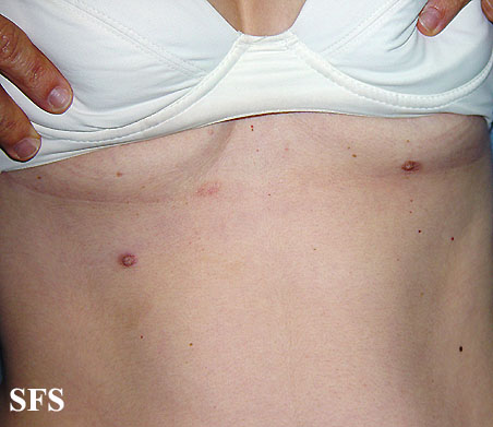 Supernumerary nipples. Adapted from Dermatology Atlas.[4]