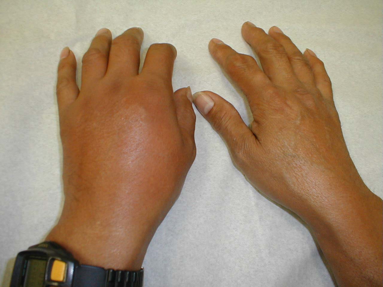 Gout of Left MCP Joints: Diffuse redness and swelling over MCP joints caused by inflammation induced by gout. Right hand is normal, for comparison.