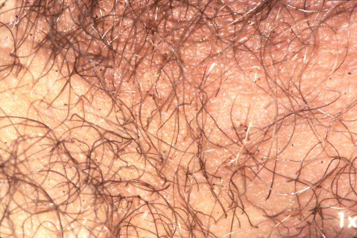 This photograph reveals the presence of crab lice, Phthirus pubis with reddish-brown crab feces. Pubic lice are generally found in the genital area on pubic hair; but may occasionally be found on other coarse body hair, such as hair on the legs, armpit, mustache, beard, eyebrows, and eyelashes. Adapted from CDC