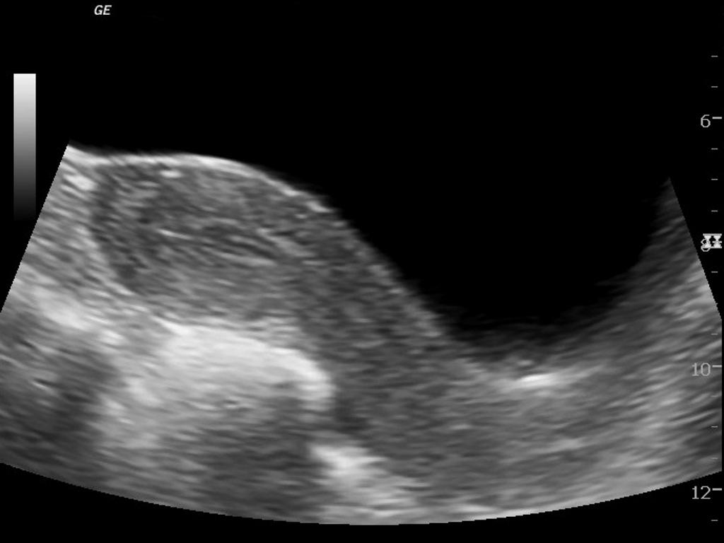 Tansabdominal USG: Ovarian dermoid uterus long axis - normal uterus. Left adnexal cystic lesion noted.[4]