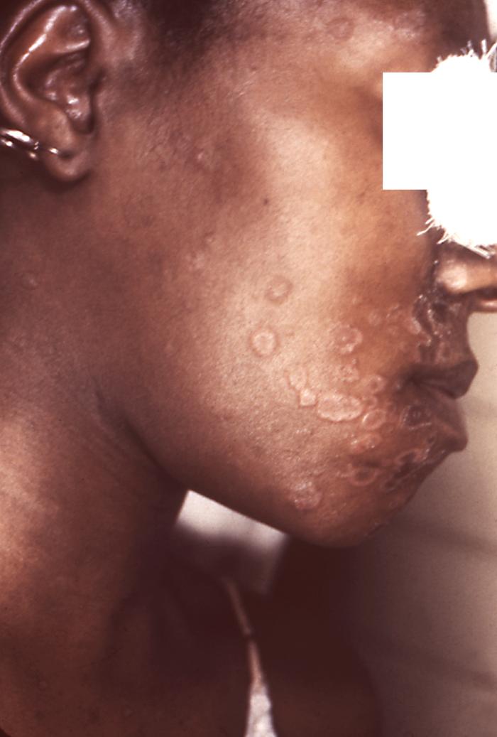This patient presented with secondary syphilitic lesions on her face. The second stage starts when one or more areas of the skin break into a rash that appears as rough, red or reddish-brown spots both on the palms of the hands and on the bottoms of the feet. Even without treatment, rashes clear up on their own. Adapted from CDC