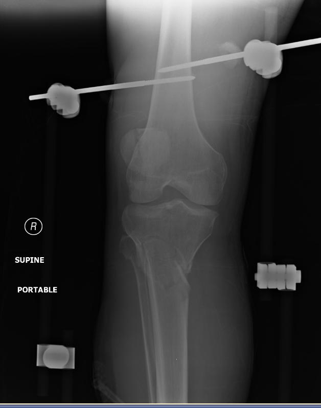 Patellar fracture. Also note tibial fracture