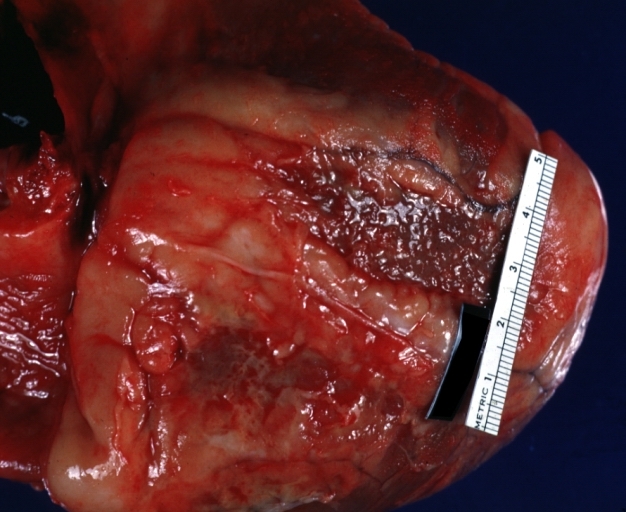 Fibrinous pericarditis: Gross, natural color, close-up view of minimal fibrinous exudate on epicardial surface due to terminal renal failure