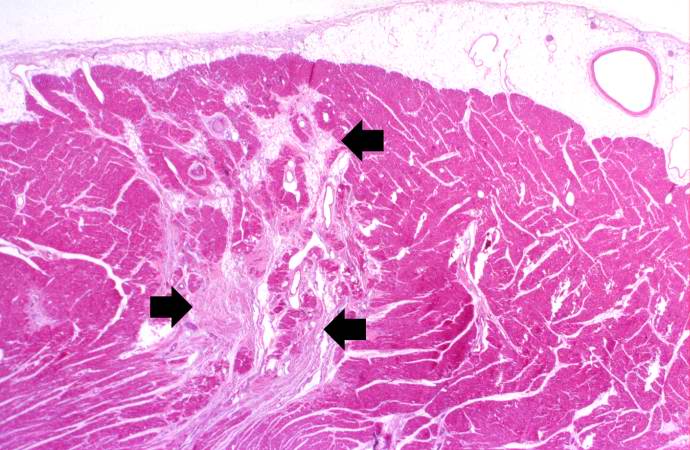 File:Polyarteritis nodosa. a case example 11.jpg