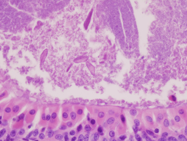 Histopathology of Warthin tumor in the parotid gland. Higher magnification of a file "Warthin tumor (1).jpg". H&E stain.[4]