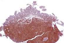 Micrograph of terminal ileum with mantle cell lymphoma (bottom of image - brown colour). Cyclin D1 immunostain.