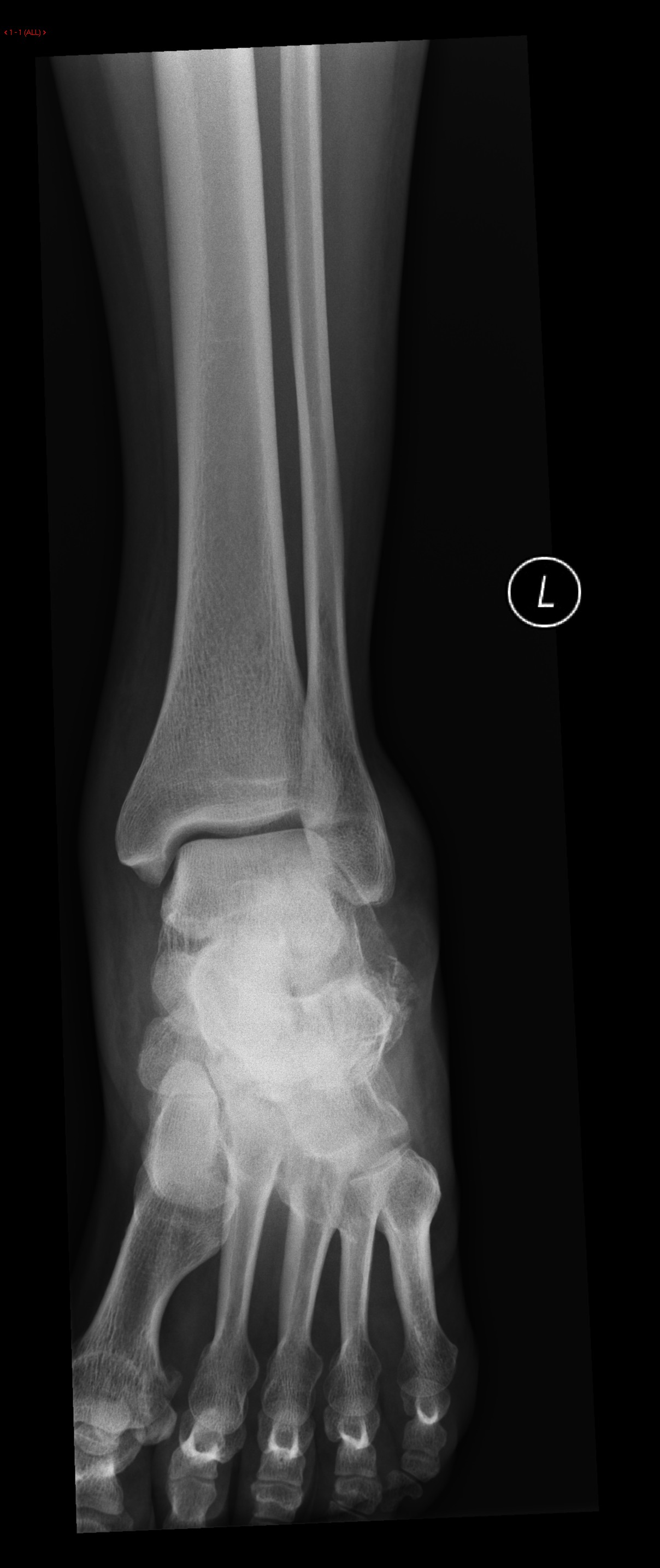File:Calcaneal-fracture-and-associated-spinal-injury.jpg