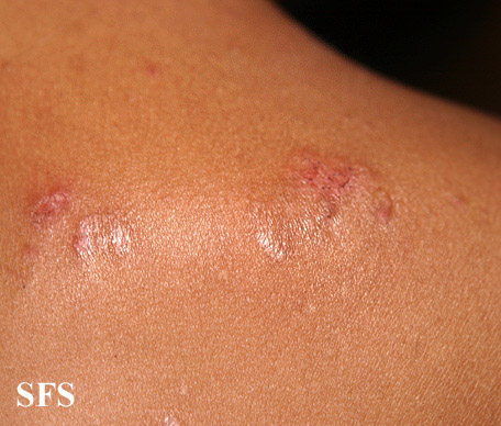 File:Dermatitis herpetiformis31.jpg