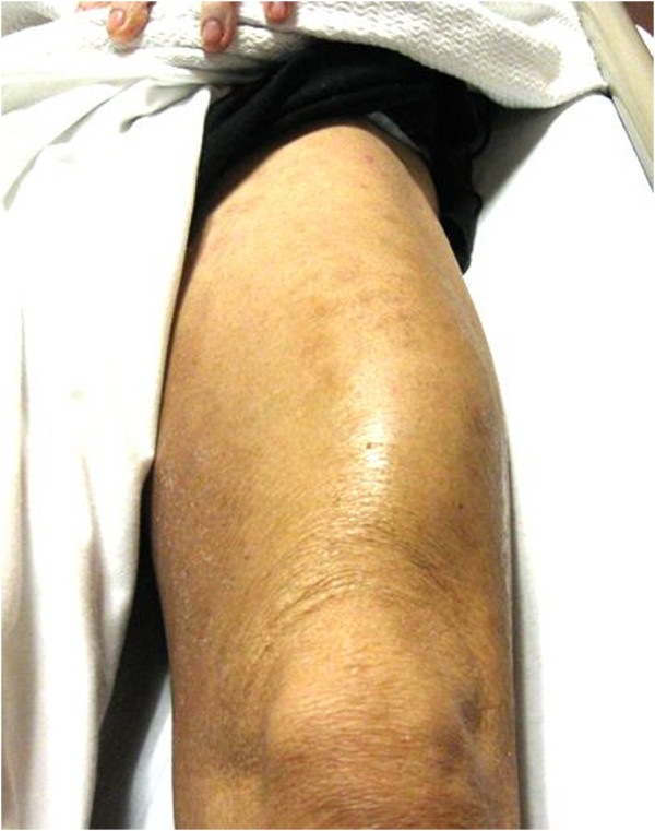 Swelling of the left quadriceps, intramuscular abscess, and pyomyositis[21]